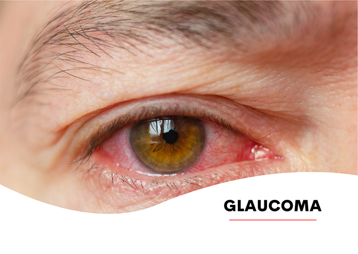 Glaucoma | Saiba tudo sobre Glaucoma | Sintomas, Tratamentos ...